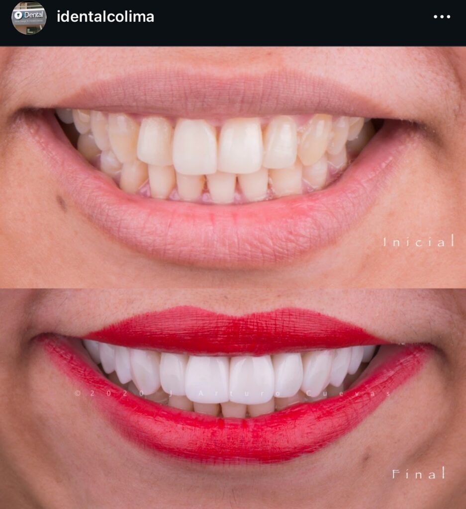 103819 dr. jorge arturo cuevas 8211 idental manzanillo 8211 diseno de sonrisa 8211 carillas dentales 8211 dentista 8211 implantes dentales 8211 937x1024