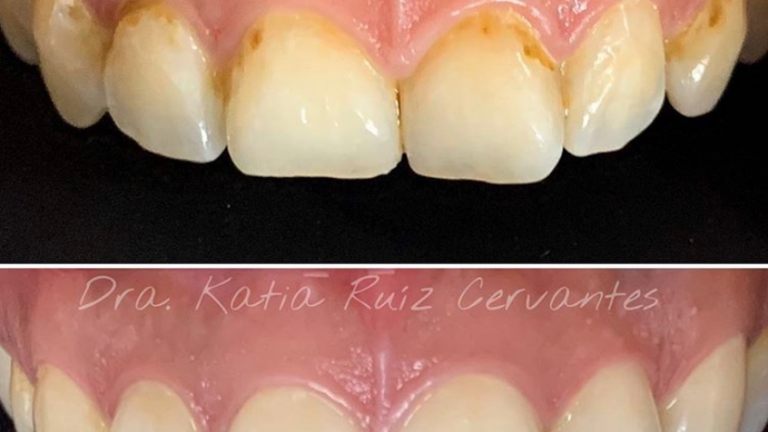 103931 implantes dentales morelia cenit odontologia avanzada dentistas en morelia diseno de sonrisa 768x432